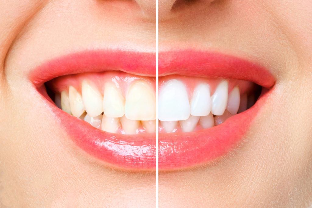 LumoSmile lifestyle image