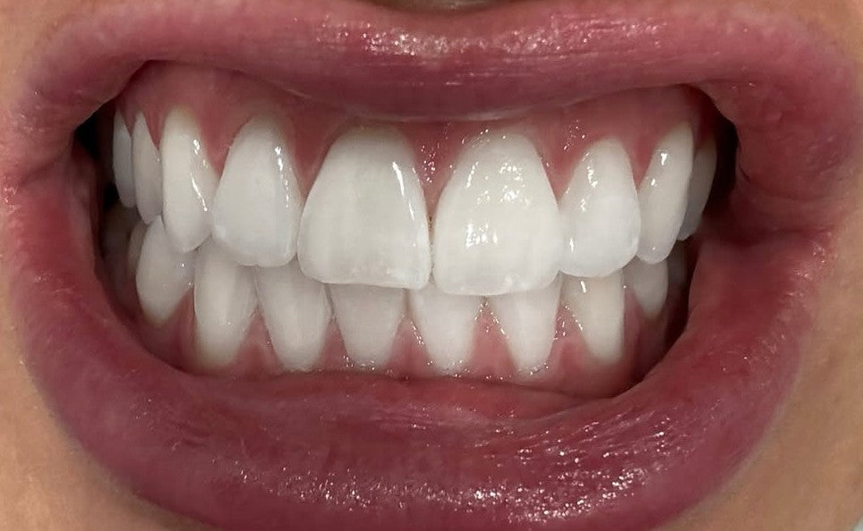 LumoSmile real result 1