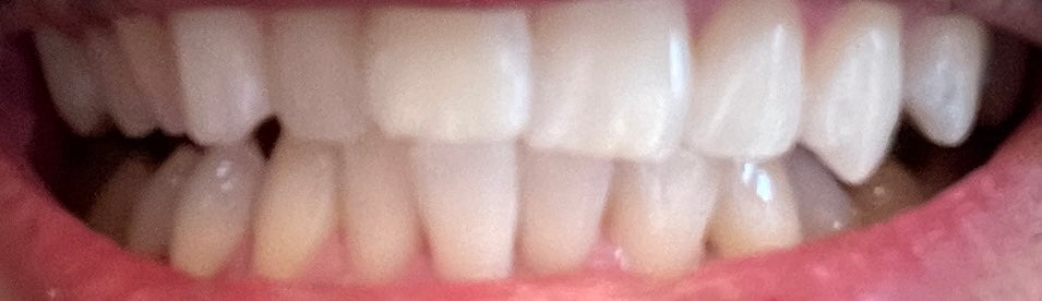 LumoSmile real result 3